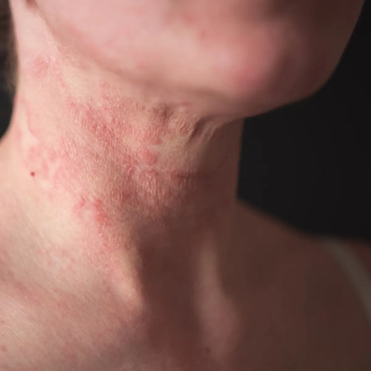 Atopijski dermatitis