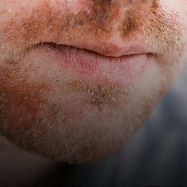 Seboroični dermatitis