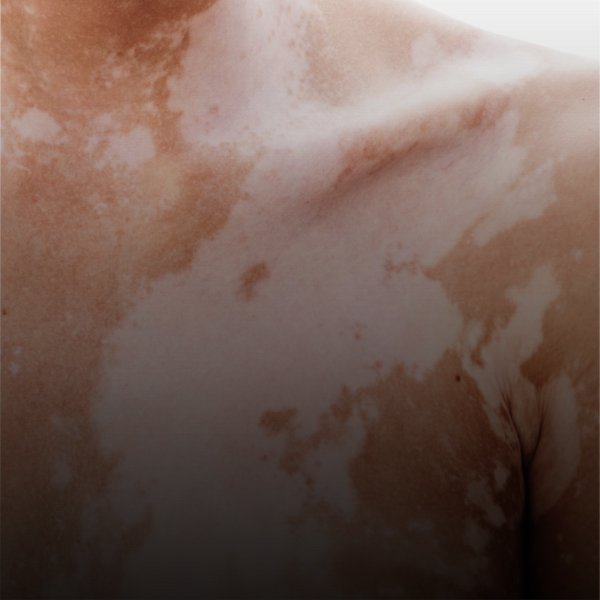 Vitiligo